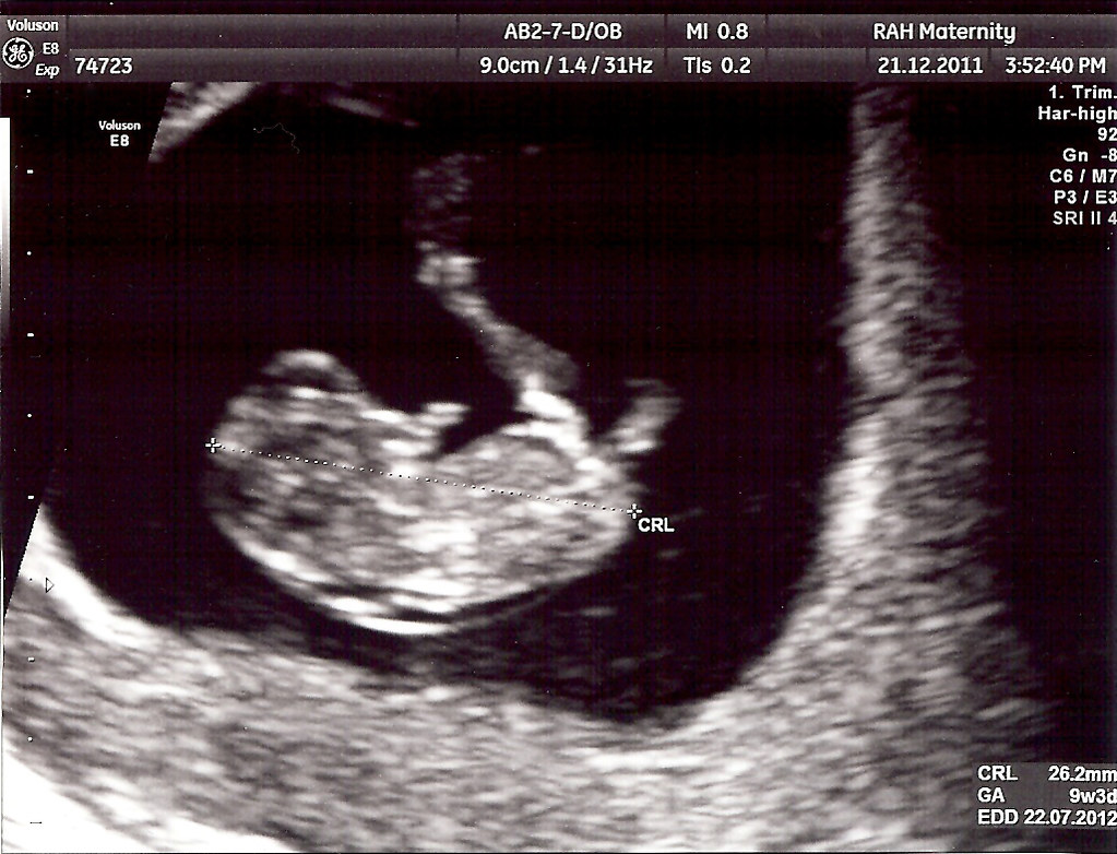 9 weeks pregnant ultrasound
