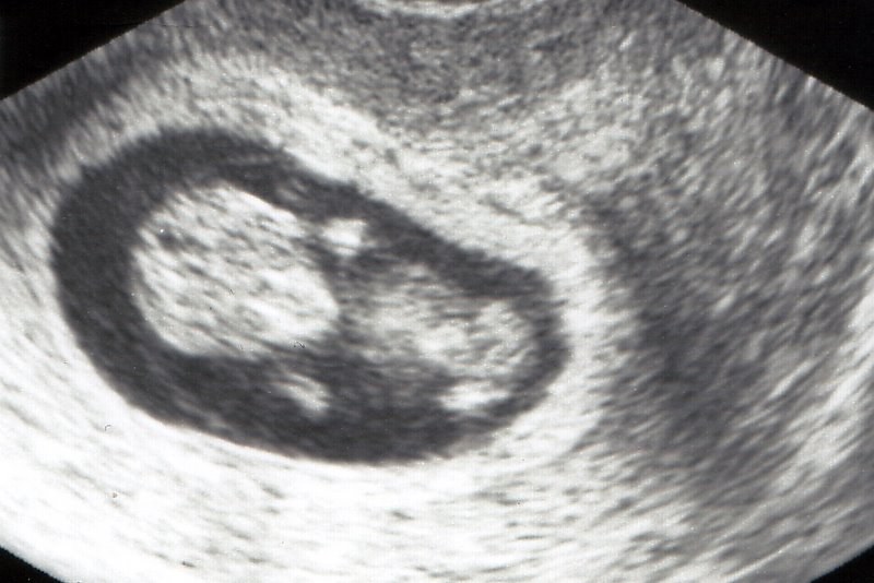 10 WEEKS PREGNANT ULTRASOUND