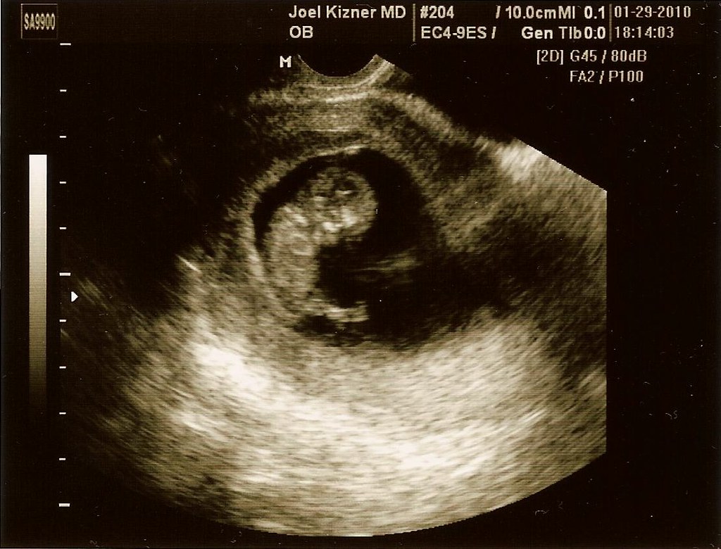 11 WEEKS PREGNANT ULTRASOUND