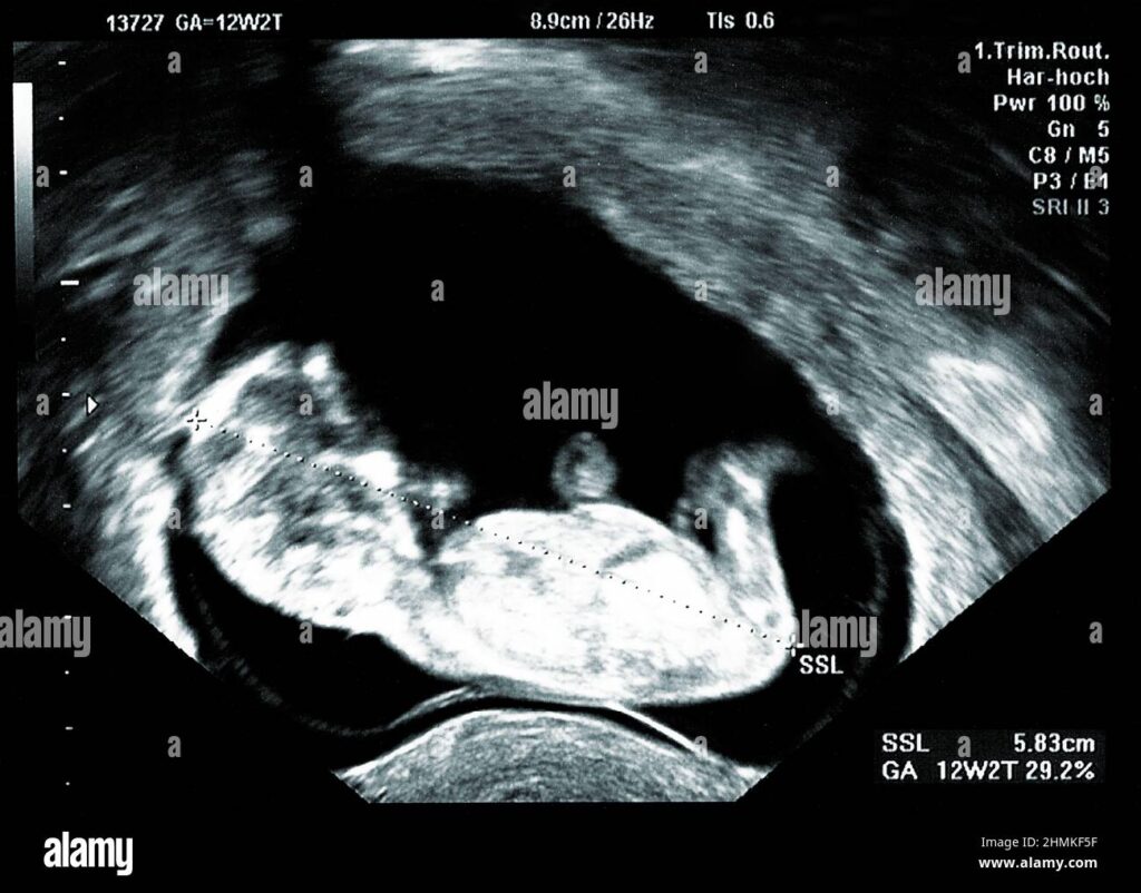 12 WEEKS PREGNANT ULTRASOUND