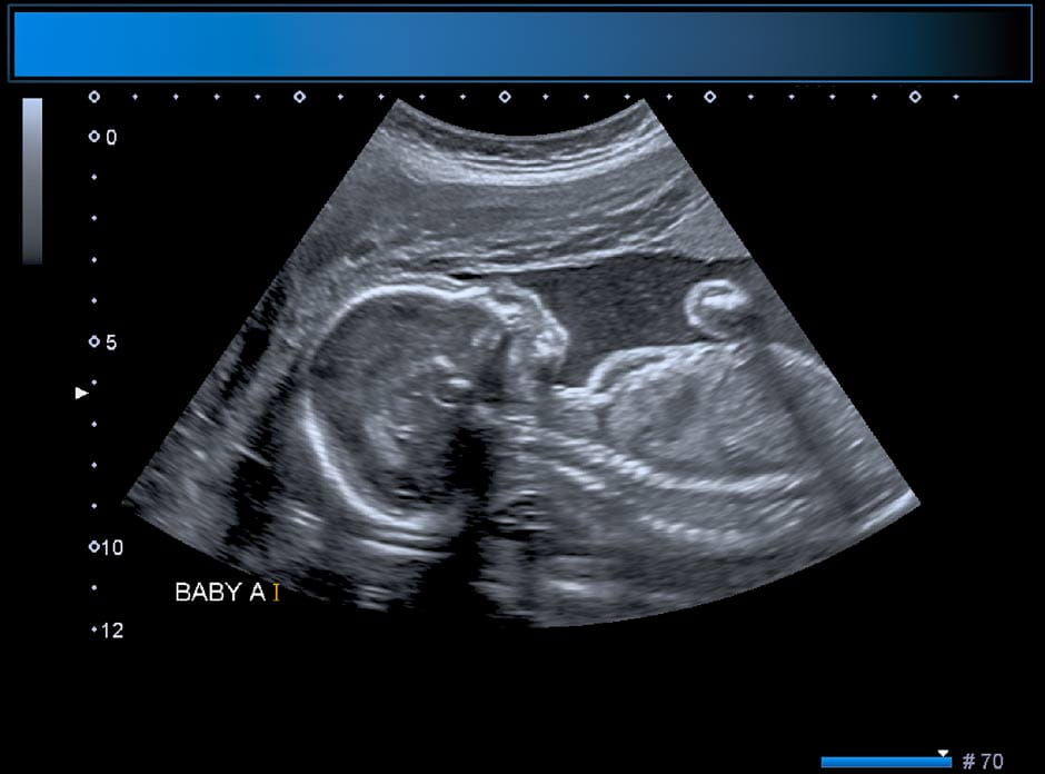 13 weeks pregnant ultrasound