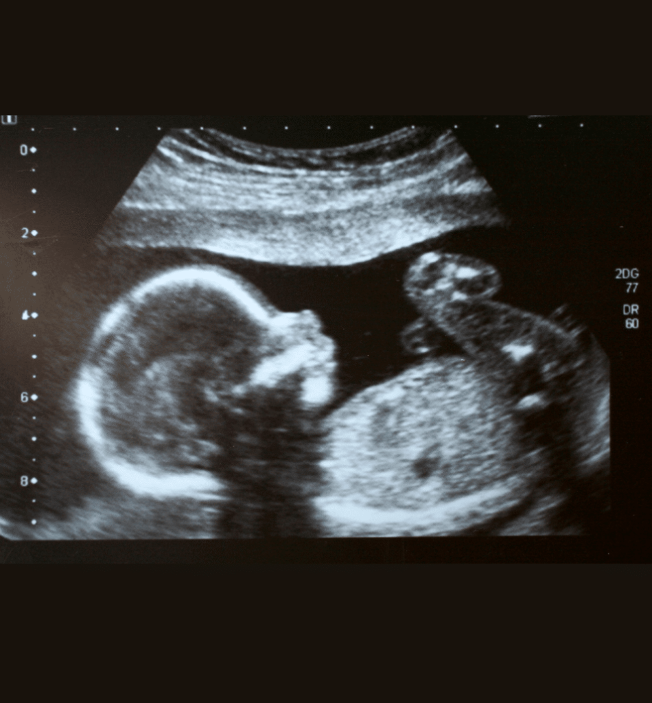 15 weeks pregnant ultrasound