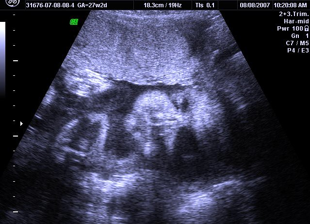 27 weeks ultrasound