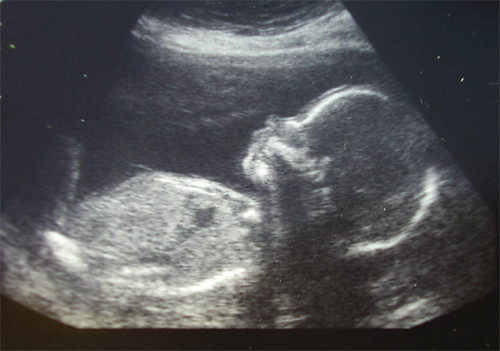 21 weeks ultrasound