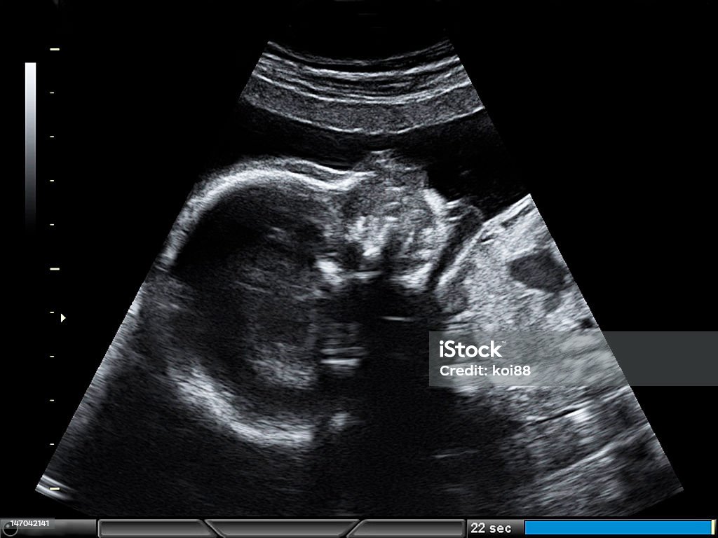 23 WEEKS PREGNANT ULTRASOUND