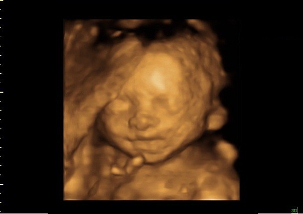 24 weeks ultrasound