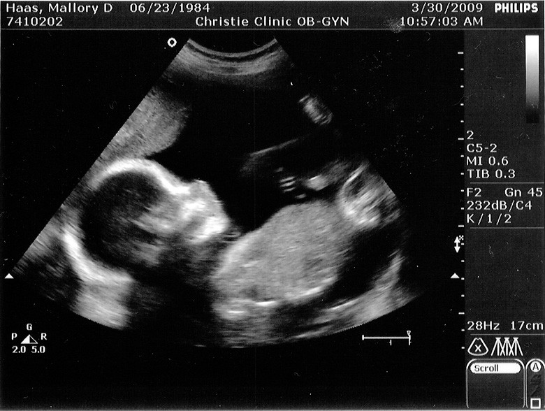 25 weeks pregnant ultrasound