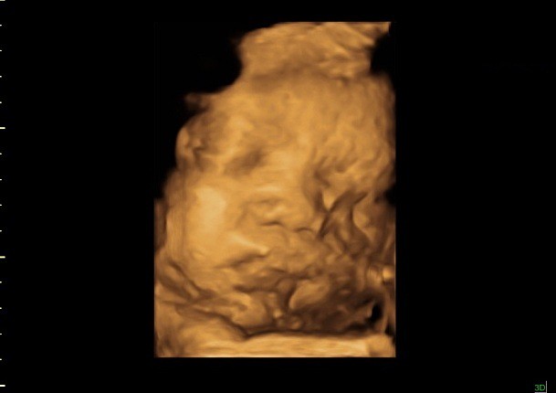 39 WEEKS FOETUS