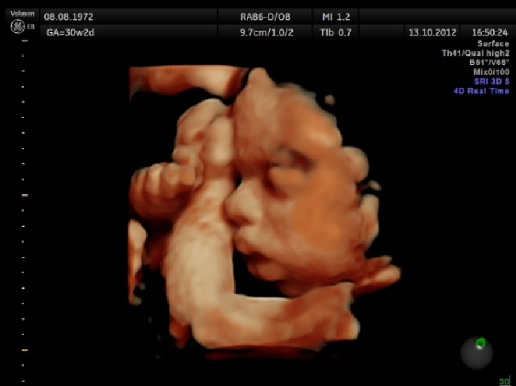 31 weeks pregnant ultrasound