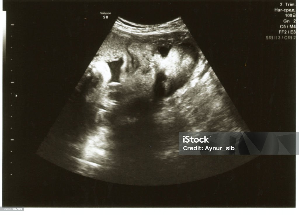 33 weeks pregnant ultrasound