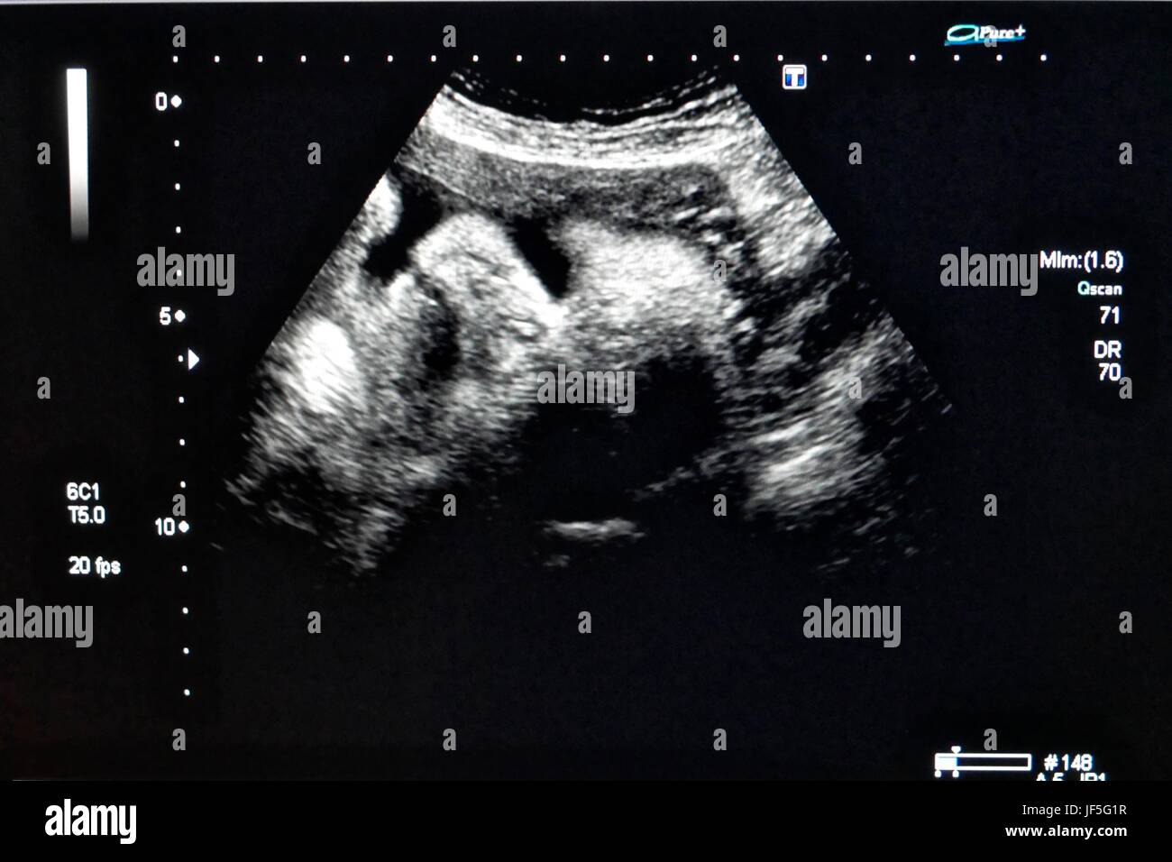 41 weeks pregnant ultrasound
