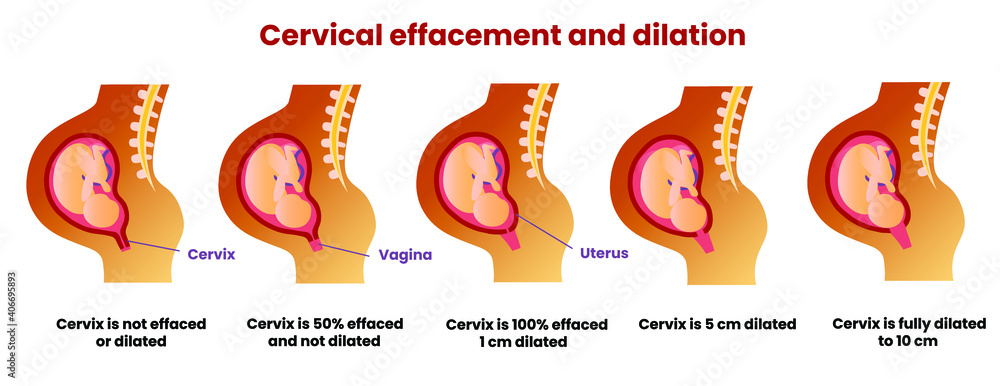 Cervical Effacement: What is it? Measurement and Significance